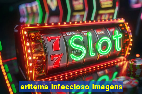 eritema infeccioso imagens